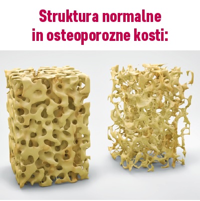 Struktura normalne in osteoporozne kosti.