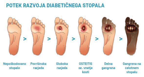 Razvoj diabetičnega stopala - slikovni prikaz.