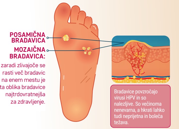 Posamična bradavica, Mozaična bradavica (zaradi zlivajoče se rasti več bradavic na enem mestu je taka oblika bradavice najtrdovratnejša za zdravljenje) Bradavice povzročajo virusi HPV in so nalezljive. Večinoma so nenevarna, a hkrati lahko tudi neprijetna in boleča težava.