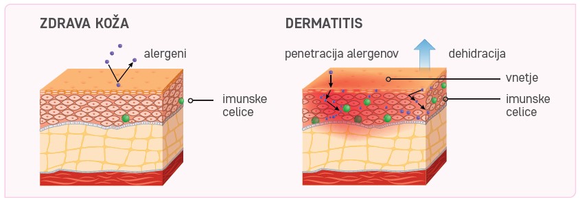 Zdrava koža primerjana s kožo ob dermatitisu.