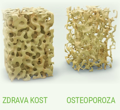 Prikaz zdrave in osteoporozne.kosti.