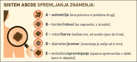 Sistem ABCD spremljanja znamenja : A- asimetrija (ena polovica ni podobna drugi) B - border/robovi (so nepravilni, z izrastki) C - color/barva (večbarvno, od svetlo rjave do črne) D - diameter/parameter (znamenje večje od 6mm) E - evolution/spreminjanje (opazna sprememba v obliki, barvi in debelini) 