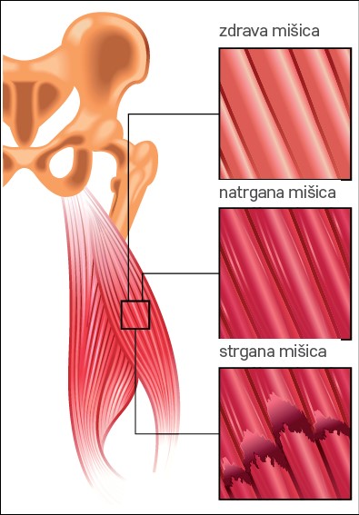 Shematski prikaz zdravega, natrganega in strganega mišičnega tkiva in razlika v mišičnih vlaknih.