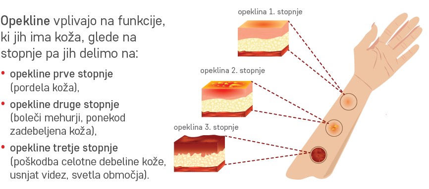 Opekline vplivajo na funkcije, ki jih ima koža, glede na stopnje pa jih delimo na : - pekline prve stopnje (pordela koža) - opekline druge stopnje (boleči mehurji, ponekod zadebeljena koža) - opekline tretje stopnje (poškodba celotne debeline kože, usnjat videz, svetla območja) (