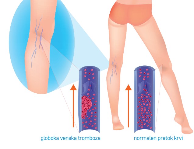 Primerjava venske tromboze in normalnega pretoka krvi.