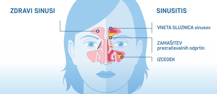 Sinusitis : Vneta sluznica sinusov, Zamašitev prezračevalnih odprtin, Izcedek iz nosa.