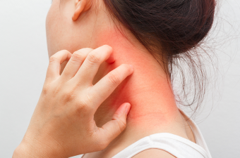 Seboroični dermatitis Seboroični dermatitis
