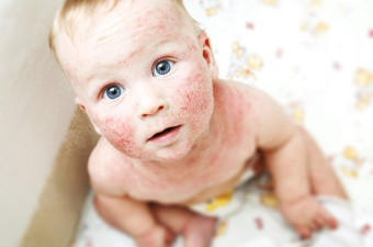 Predavanje: Atopijski dermatitis in pomen nege kože Predavanje: Atopijski dermatitis in pomen nege kože