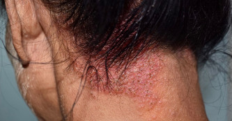 Suha koža, dermatitisi in nega (2. del)