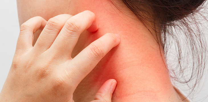 Seboroični dermatitis Seboroični dermatitis